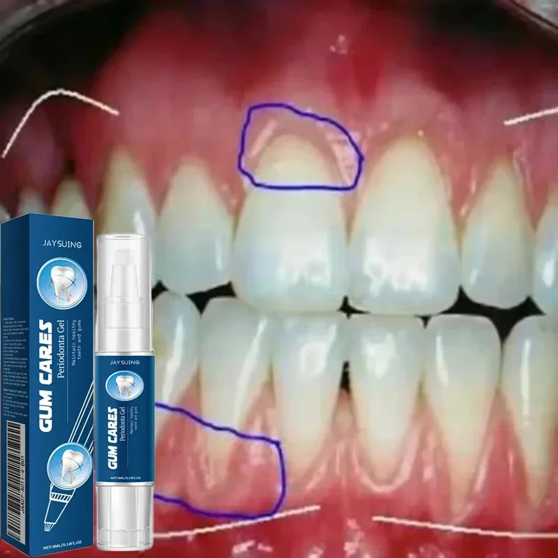 Gel de soin réparateur de gencives endommagées, soulage les gencives maléfiques, nettoyage en profondeur des dents, taches, sérum tartre, dentifrice pour caries dentaires Gel de soin réparateur de gencives endommagées, soulage les gencives maléfiques, nettoyage en profondeur des dents, taches, sérum tartre, dentifrice pour caries dentaires