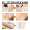 sakura crème d'épilation rapide indolore inhibiteur de croissance des cheveux bras aisselles jambes zones intimes dépilatoire permanent pour hommes femme