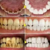 stylo de blanchiment des dents blanc éblouissant, stylo de blanchiment des dents instantané, éclaircit votre sourire, outils de soins d'hygiène des dents