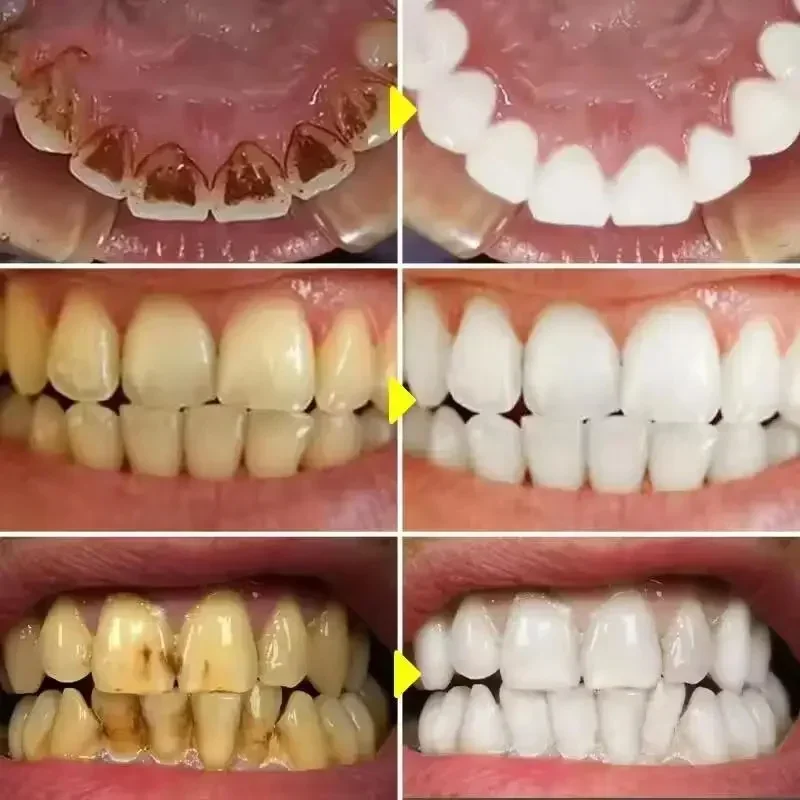 stylo de blanchiment des dents blanc éblouissant, stylo de blanchiment des dents instantané, éclaircit votre sourire, outils de soins d'hygiène des dents stylo de blanchiment des dents blanc éblouissant, stylo de blanchiment des dents instantané, éclaircit votre sourire, outils de soins d'hygiène des dents