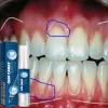 gel de soin réparateur de gencives endommagées, soulage les gencives maléfiques, nettoyage en profondeur des dents, taches, sérum tartre, dentifrice pour caries dentaires